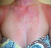 alergija na sunce